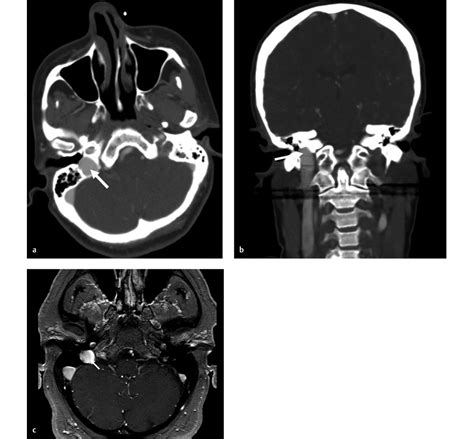 8 High Riding Jugular Bulb Radiology Key