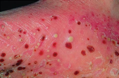 Pustular Psoriasis