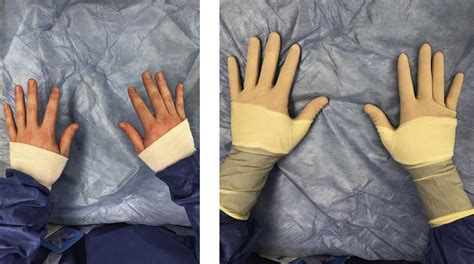 Donning A Sterile Gown And Gloves Closed Method - Images Gloves and ...