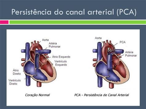 Persistencia Do Canal Arterial Sololearn