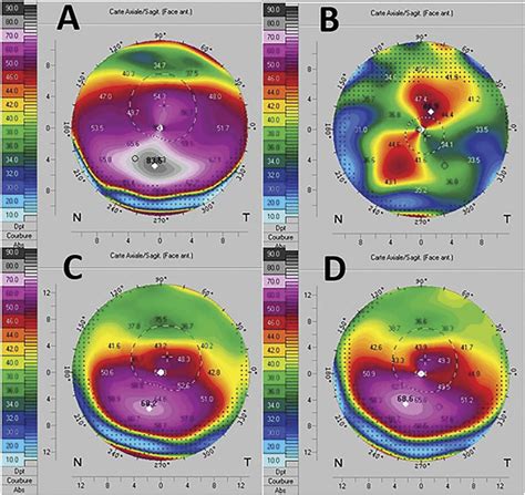 Scheimpflug Based Corneal Topography Of The Left Eye Os A