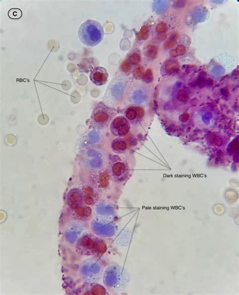 Urine Sediment of the Month: White Blood Cells, “Glitter Cells”, and ...