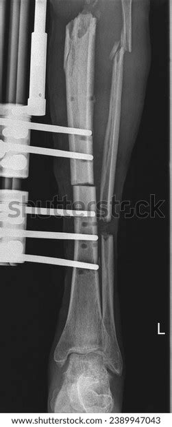 Tibial Shaft Fracture Fixation X-ray External Stock Photo 2389947043 ...