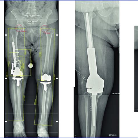 Distal femur replacement with a megaprosthesis in a failed ...