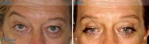 Portfolio Blépharoplastie Dr Ben Jemaa