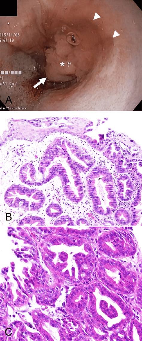 A An Endoscopic Image Of A Mass Protruding From The Mucosa Of The