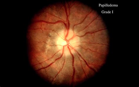 Clin Med HEENT Neuro Ophthalmology Lecture Terminology Flashcards