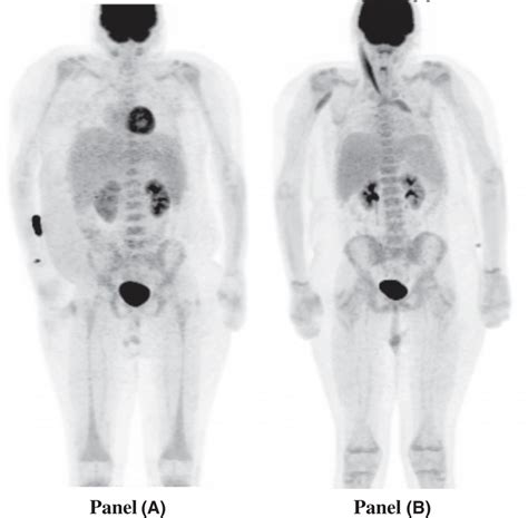 Initial And Followup Nuclear Medicine Positron Emission Computed