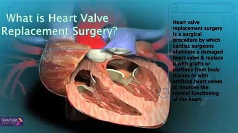 Heart Valve Replacement Surgery Procedure