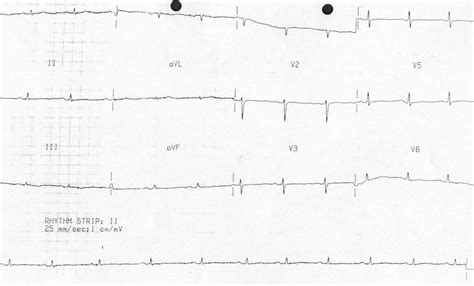 ECG Case 063 • LITFL • ECG Top 100 Self-Assessment Quiz