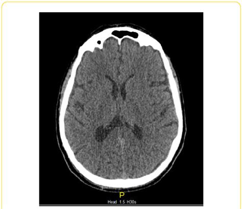 Pneumocephalus resolved. | Download Scientific Diagram