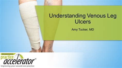 Understanding Venous Leg Ulcers | WoundSource