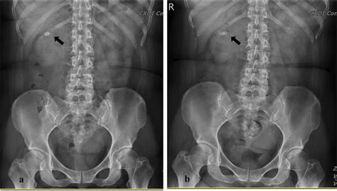 Pre-ESWL (a) and post-ESWL (b) of right renal upper calyceal stone. The ...