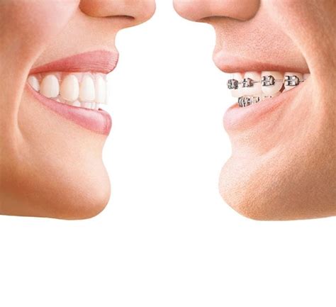 Brackets De Porcelana Vs Met Licos Cu L Elegir Cl Nica Dental Gomeza