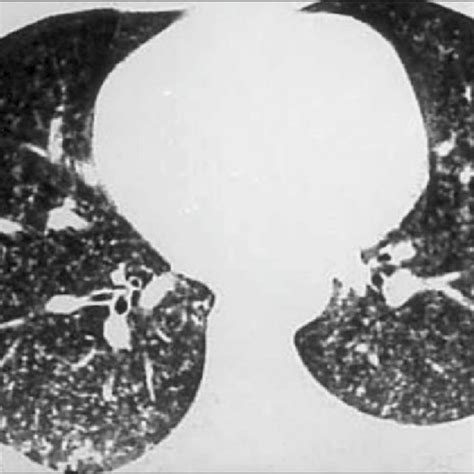 Chest CT scan revealing multiple micronodules at the lung parenchyma,... | Download Scientific ...