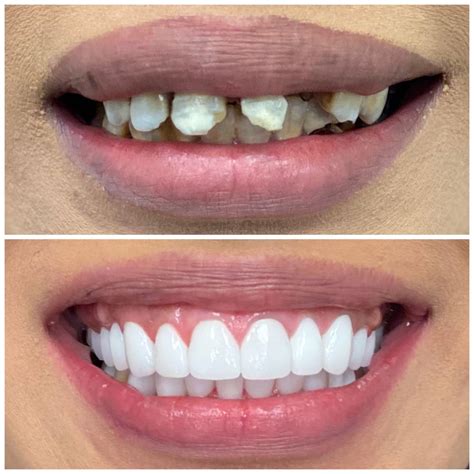 Smile Makeover Before And After