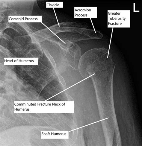 Proximal Humerus Fracture Splint