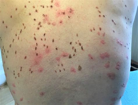 Seborrheic Keratosis Cryotherapy Before After