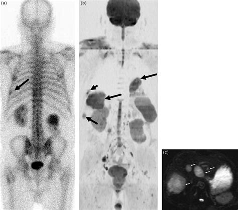 Diffusion Weighted Whole Body Mr Screening European Journal Of Radiology