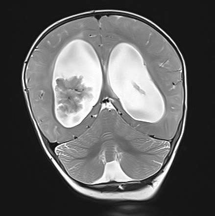 Choroid Plexus Papilloma Image Radiopaedia Org