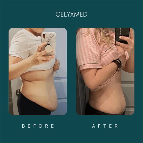 Tummy Tuck In Turkey All Included Celyxmed