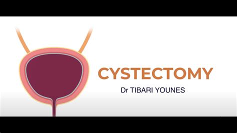 Bladder Cancer Treatment Female Cystectomy Dr Tibari Youtube