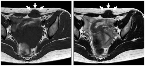 Cases Of Abdominal Wall Endometriosis Distinguished From Soft Tissue