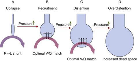 Principles of Lung-Protective Ventilation | Obgyn Key