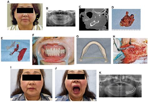 Figure From Stereolithographic Model Assisted Reconstruction Of The