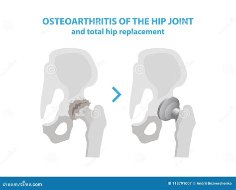 Osteoarthritis Of The Hip Joint And Hip Replacement Surgery Medical Infographic Elements ...