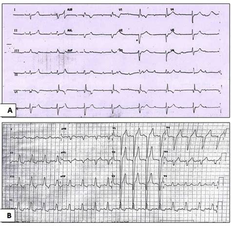 Figure From Severe Left Ventricular Systolic Dysfunction After