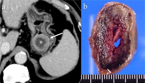 Cystic Degeneration Of A Gastrointestinal Stromal Tumor In The Stomach