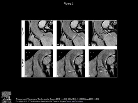 Restricted Cusp Motion In Right Left Type Of Bicuspid Aortic Valves A