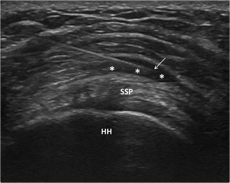 The Effect Of Injection Volume On Long Term Outcomes Of Us Guided Subacromial Bursa Injections