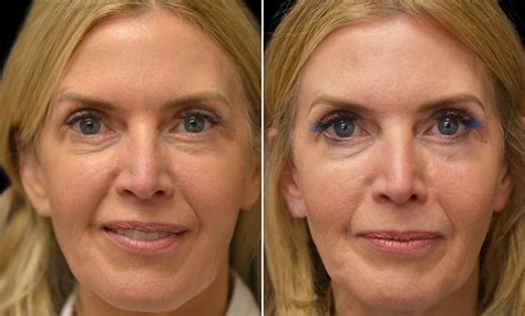 Description Bilateral Upper And Lower Blepharoplasty Septal Window