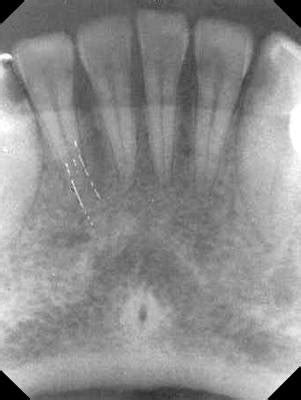 Mental Fossa Radiograph