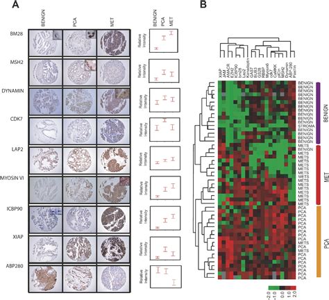 Integrative Genomic And Proteomic Analysis Of Prostate Cancer Reveals