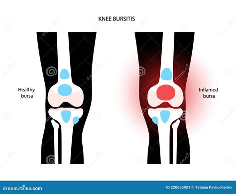 Knee Bursitis_Prepatellar Bursitis Vector Illustration | CartoonDealer ...