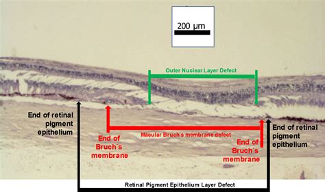 Myopic Macular Bruch’s Membrane Defects Heliyon