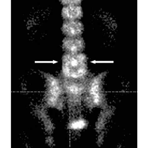 Technetium-99 m bone scan shows increased uptake of radioisotopes on ... 