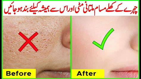 How To Get Rid Of Large Open Pores Permanently Acne Scars Naturally