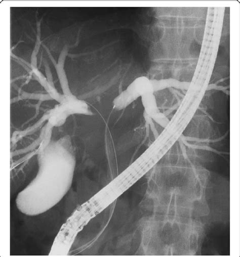 Cholangiographic Finding Cholangiography After Ercp And Enbd Showed Download Scientific