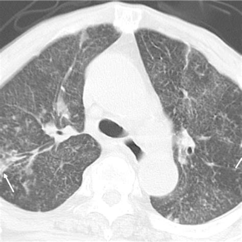 Chest Ct On Admission Chest Ct Shows Multiple Miliary Nodular Shadows