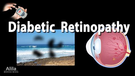 Retinopathy: Diabetic and Hypertensive, Animation. - Diabetes