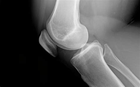 Knee Cartilage Repair; a procedure is undertaken to replace damaged ...