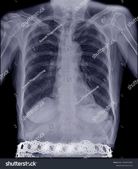 Xray Lungs Elderly Women Pneumonia Emphysema Stock Photo 2206914963 | Shutterstock