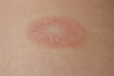 Lichen Planus Causes Clear Skin Clinic