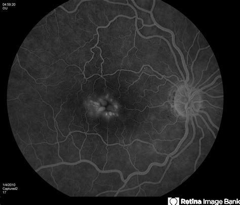 Cystoid Macular Edema Retina Image Bank