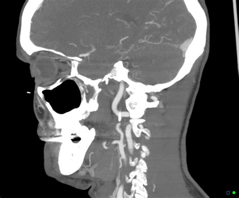 Vertebral Artery Fenestration V Segment Image Radiopaedia Org