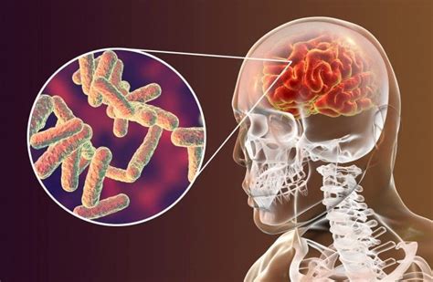 Entenda os diferentes tipos de meningite e como evitá los